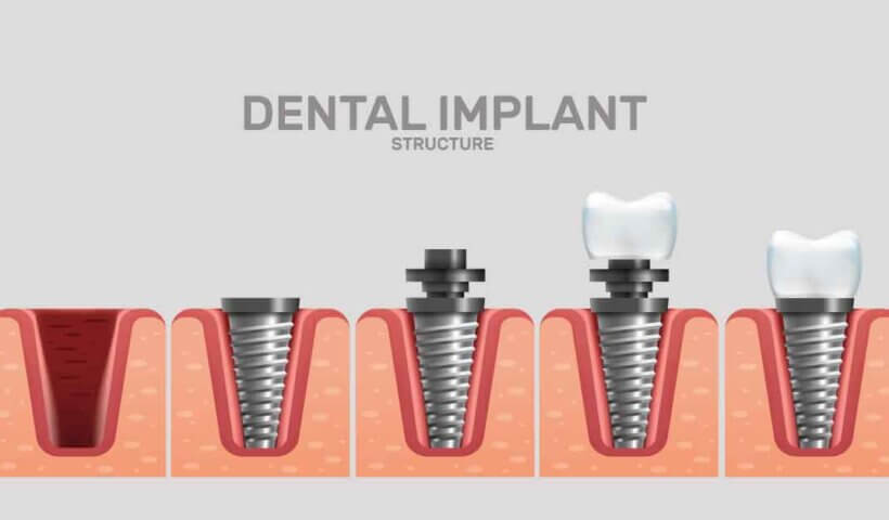 detal implant 1200x628 2 6개 보험사의 치아보험 비교표로, 부부가 각각 다르게 가입하다