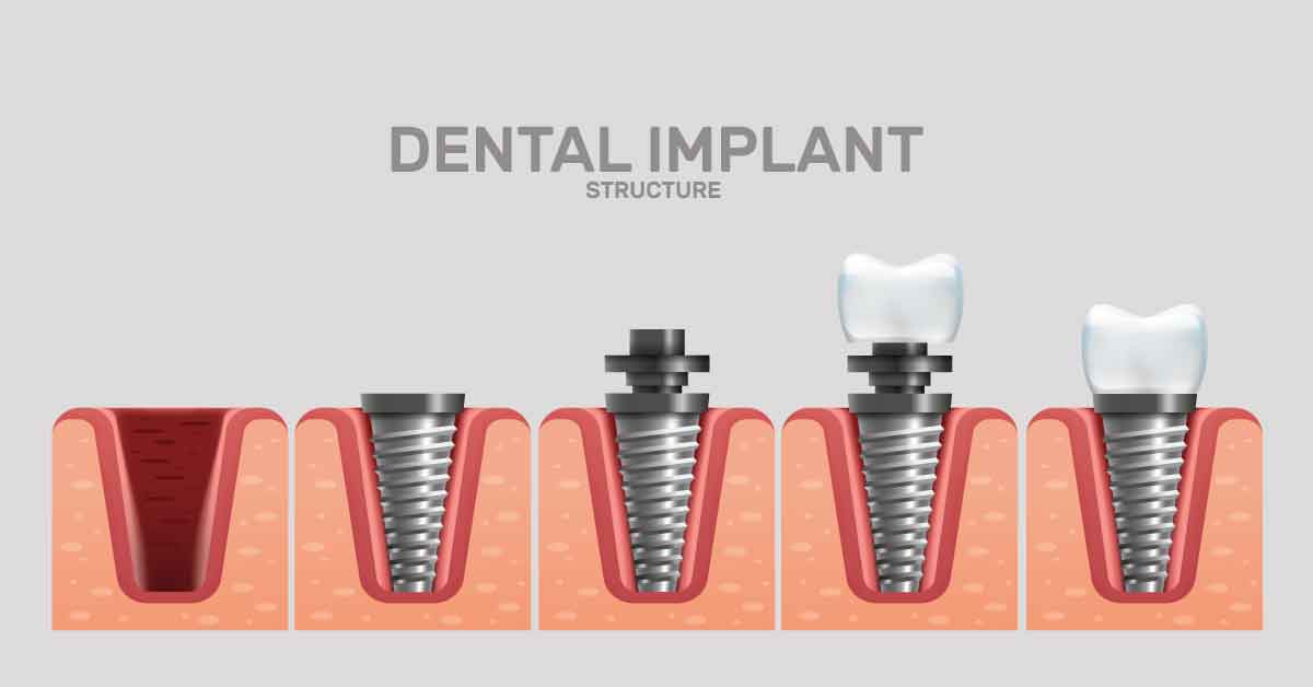 detal implant 1200x628 2 치아보험,비교,임플란트,크라운,브릿지,사례 치아보험 비교하고 부부가 각각 다른 보험사에 가입한 사례